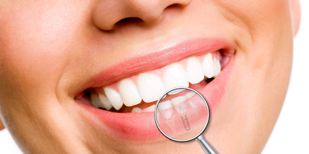 #DentiBelli - Quando e perchè ricorrere agli impianti dentali