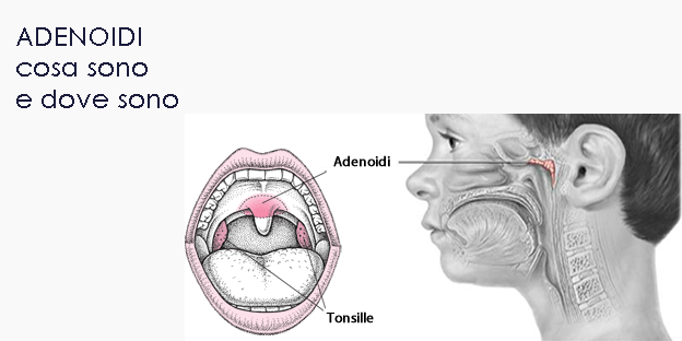 #OTORINO - Bambini e adenoidi: quando la barriera protettiva diventa essa stessa un focolaio di infezione