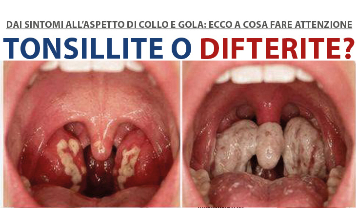 Difterite i tonsillite? Come riconoscerle e cosa fare